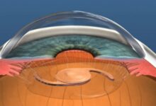 Refractive Lens Exchange