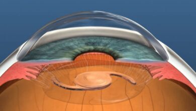 Refractive Lens Exchange