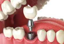 The Role of Dental Implants in Reducing Oral Health Inequality