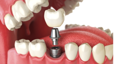 The Role of Dental Implants in Reducing Oral Health Inequality